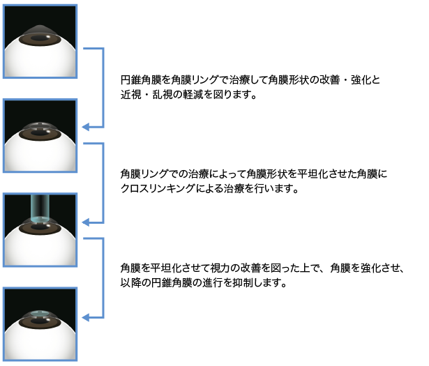 レーザー角膜リング | 銀座の眼科 | 冨田実アイクリニック銀座