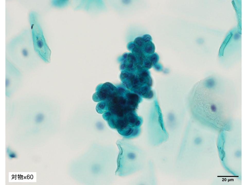 第16回 スライドカンファレンス症例 ｜ 泌尿器細胞診(別府)カンファレンス