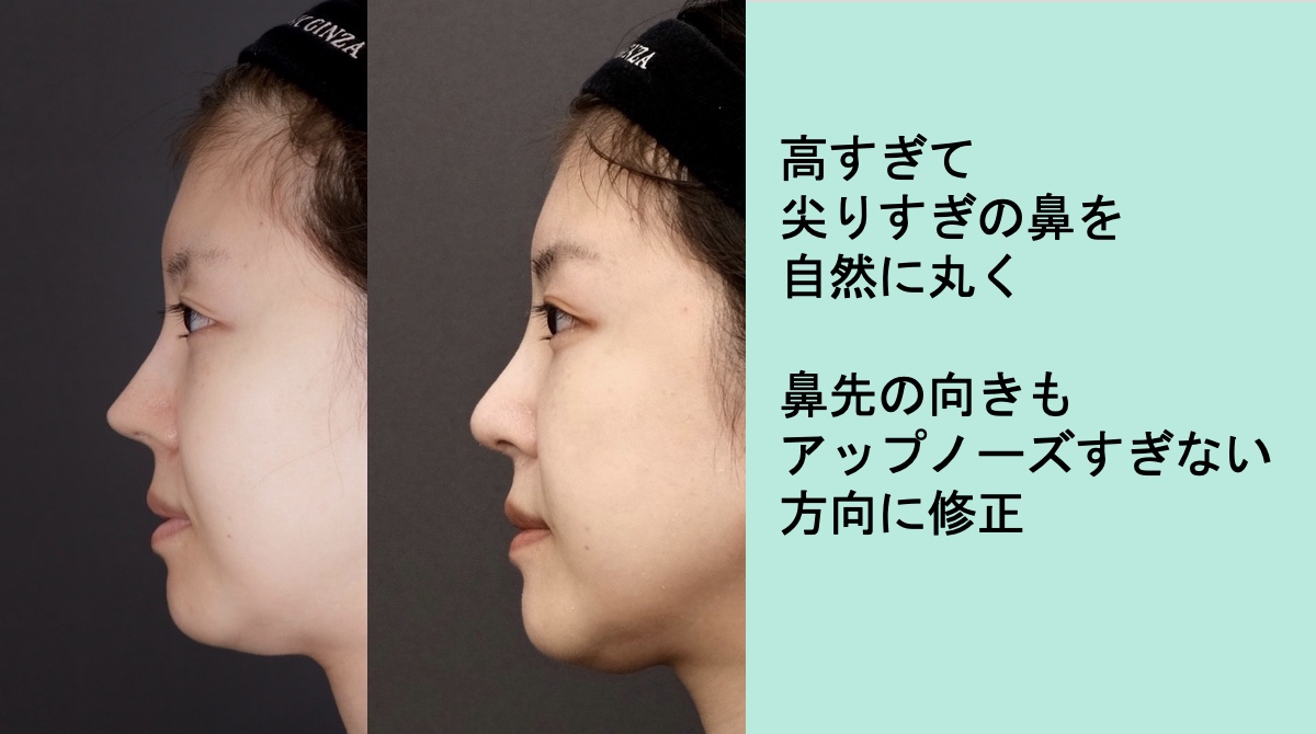韓国でアップノーズになりすぎた鼻をナチュラルになおすNo.1243 - WOM