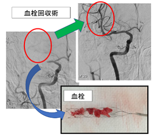脳梗塞の超急性期治療：血栓回収療法 ｜脳神経外科｜診療科・部門紹介