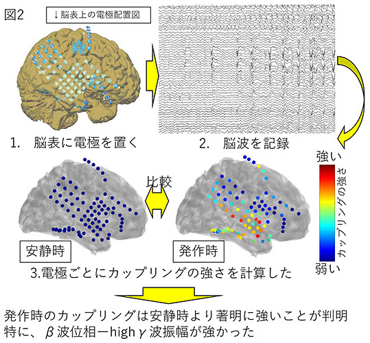 てんかん発作時の特徴的な脳波を世界で初めて検出―病態解明や診断精度