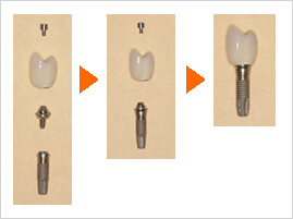ブローネマルクシステム-当医院の使用するインプラントシステム-｜朝霧