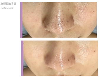 あらゆるお肌トラブルに！毛穴レス肌に導く万能フェイシャルコース