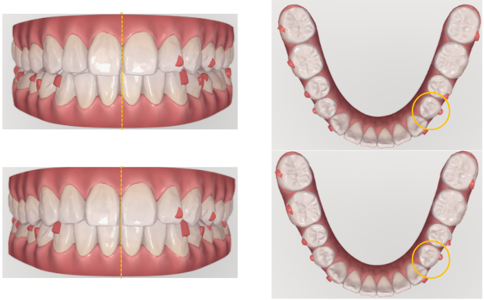 治療経過「追加アライナーへ」 | 千葉県柏市で歯列矯正なら柏KT矯正歯科