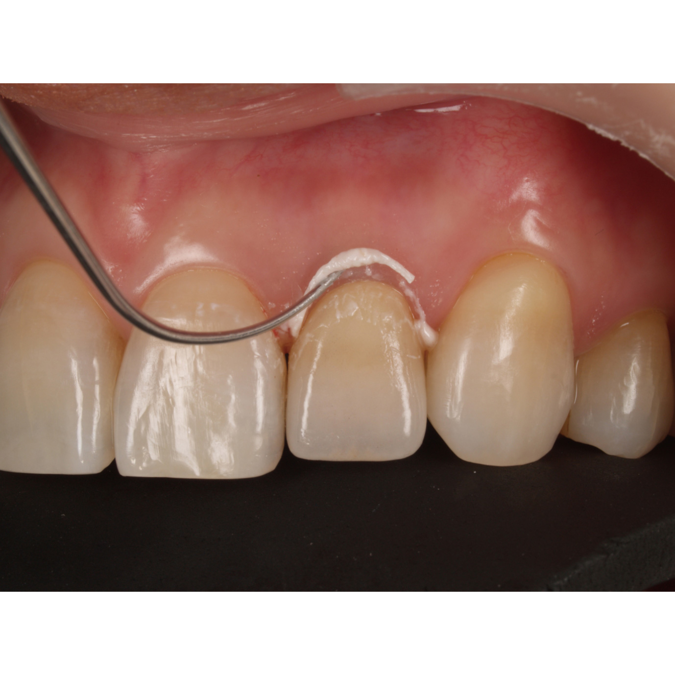 インプラントセメント |