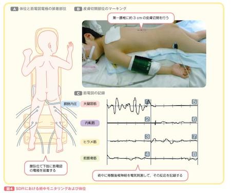 機能神経外科 痙縮(脳性麻痺など) | 東京女子医科大学脳神経外科