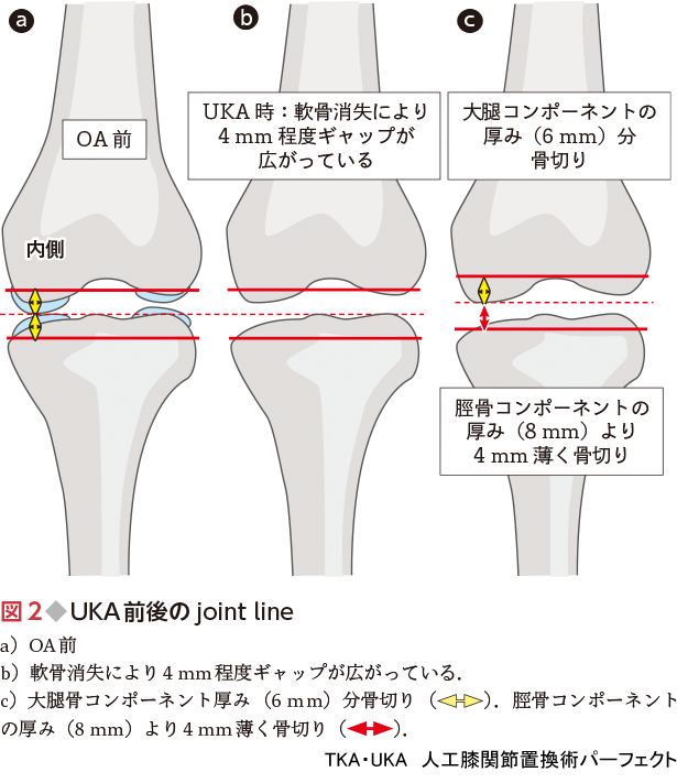 TKA・UKA 人工膝関節置換術パーフェクト〜人工膝関節全置換術・人工膝