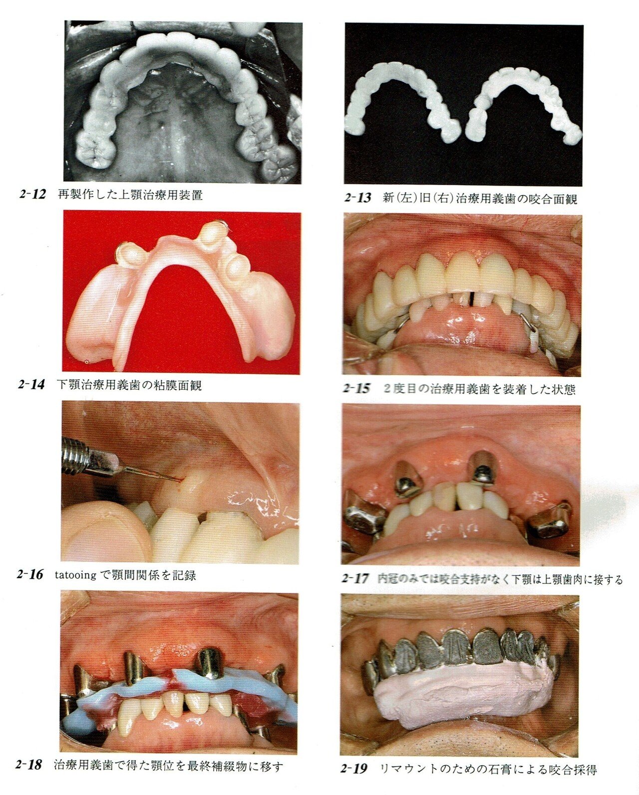 図解・咬合採得 図解・咬合採得 7 咬合採得①／垂直的顎