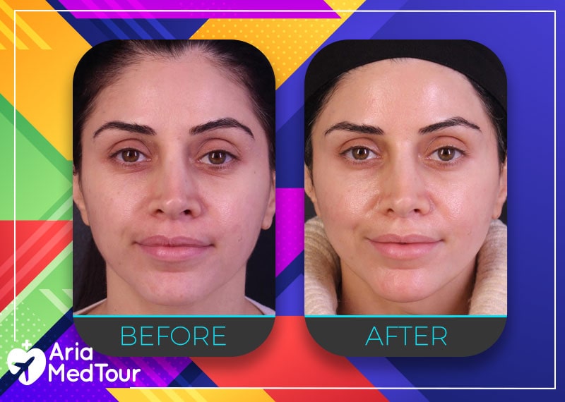 Best Non-Surgical Skin Tightening Procedures - AriaMedTour