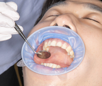 FEEDデンタル】オプトラゲートの通販｜開口器、ティッシュリトラクター