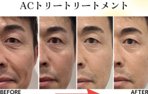 美容液導入器ACトリートメントの効果や口コミは？特徴や導入費用をご