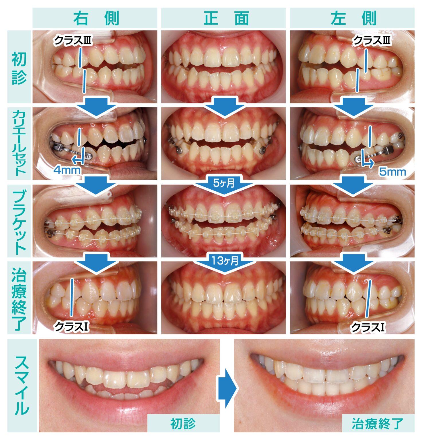 Vol.160 カリエールの使用により外科的矯正治療を回避できた症例 | ふ