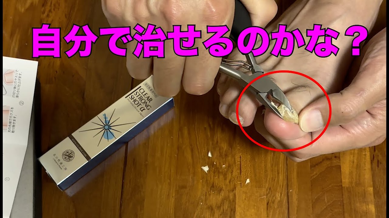 Nail Fungus Treatment] Is this nail fungus? Try treating it with