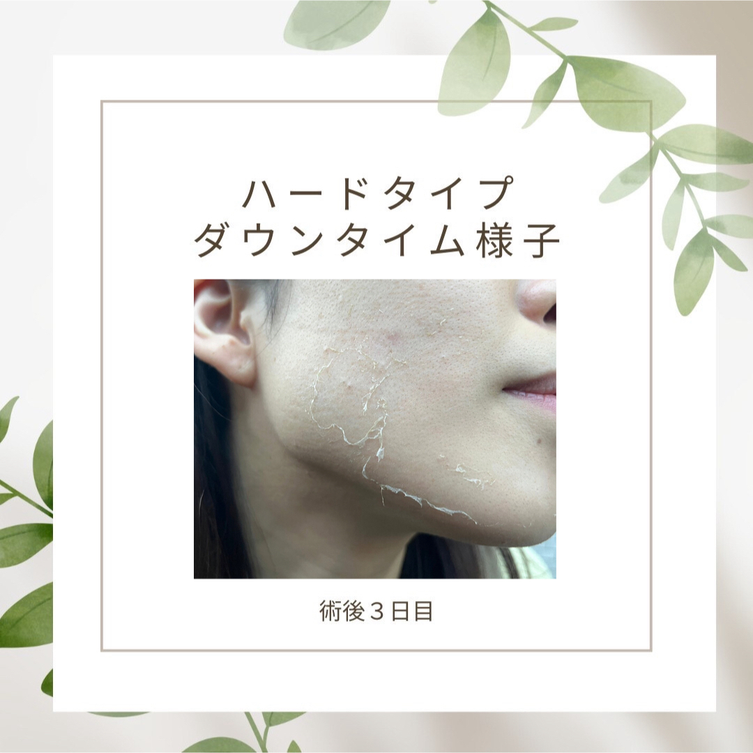 12月31日まで【大特価年末セール】剥離ありハーブピーリング20回分