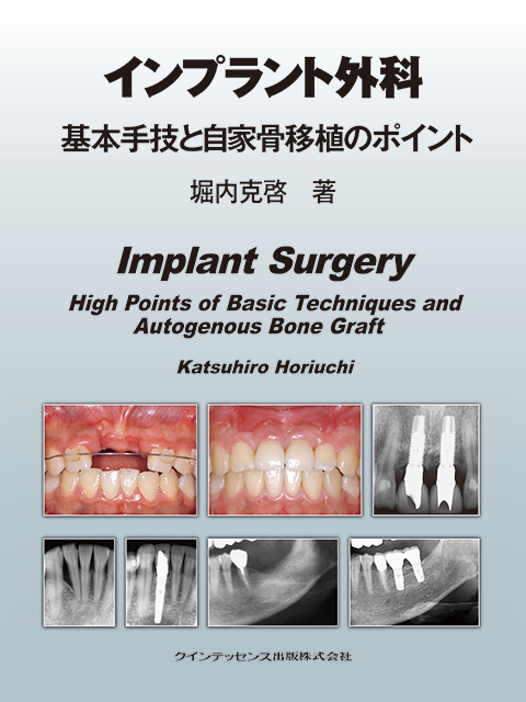 CTで検証する サイナスフロアエレベーションの落とし穴（CTで検証する
