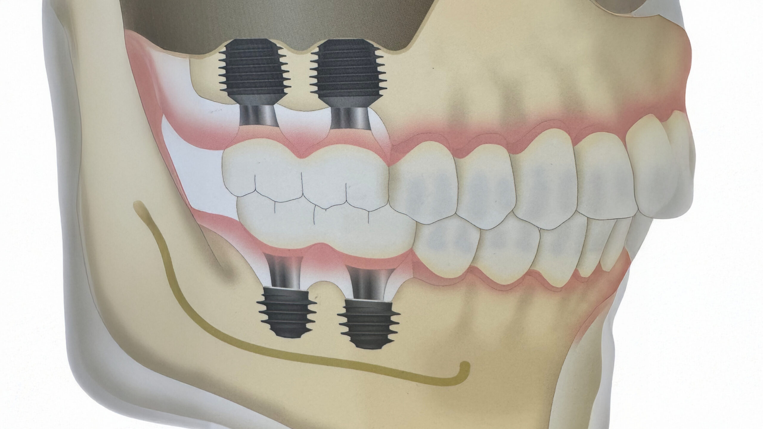 最新技術導入】エクストラワイドショートインプラントとは？ | 芝公園