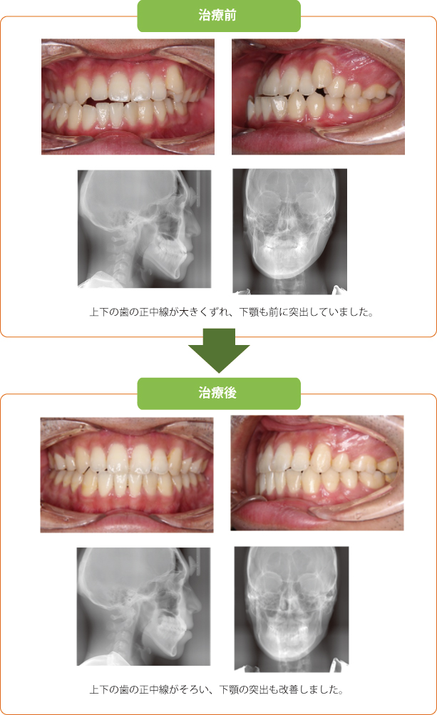 外科症例 豊田市 矯正歯科 専門 こんどう矯正歯科 愛知県豊田