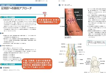 下腿・足の手術[DVD付] (整形外科手術イラストレイテッド) | 木下光雄