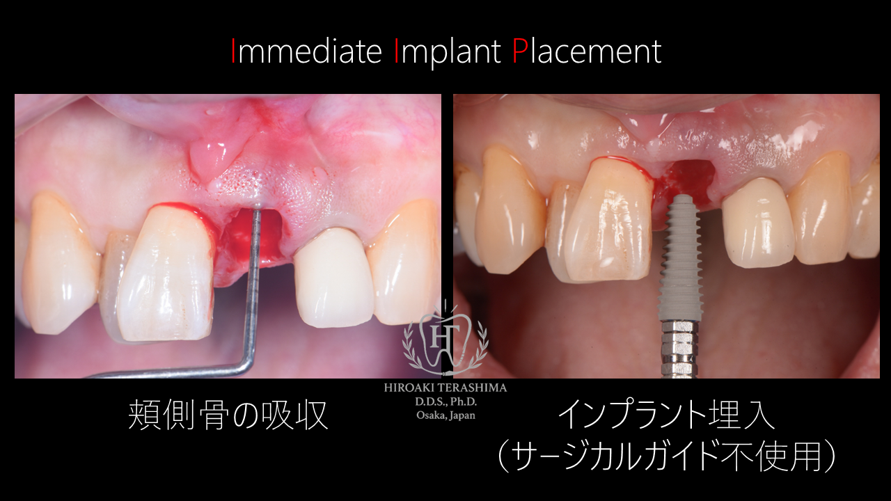 前歯が折れた場合の治療法｜抜歯即時インプラントによる審美回復症例