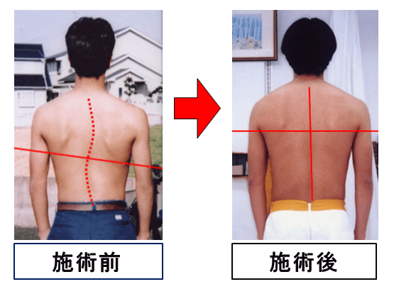 福岡で側弯症を改善するなら緑カイロ整体院