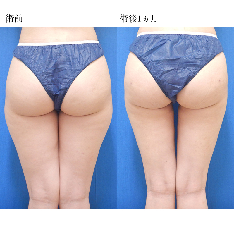 太もも・お尻の脂肪吸引 | 名古屋栄の美容整形外科・美容皮膚科は