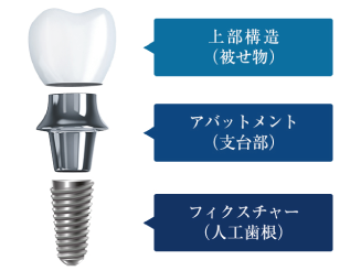 インプラント治療の流れ - 宮崎北歯科医院（宮崎市）