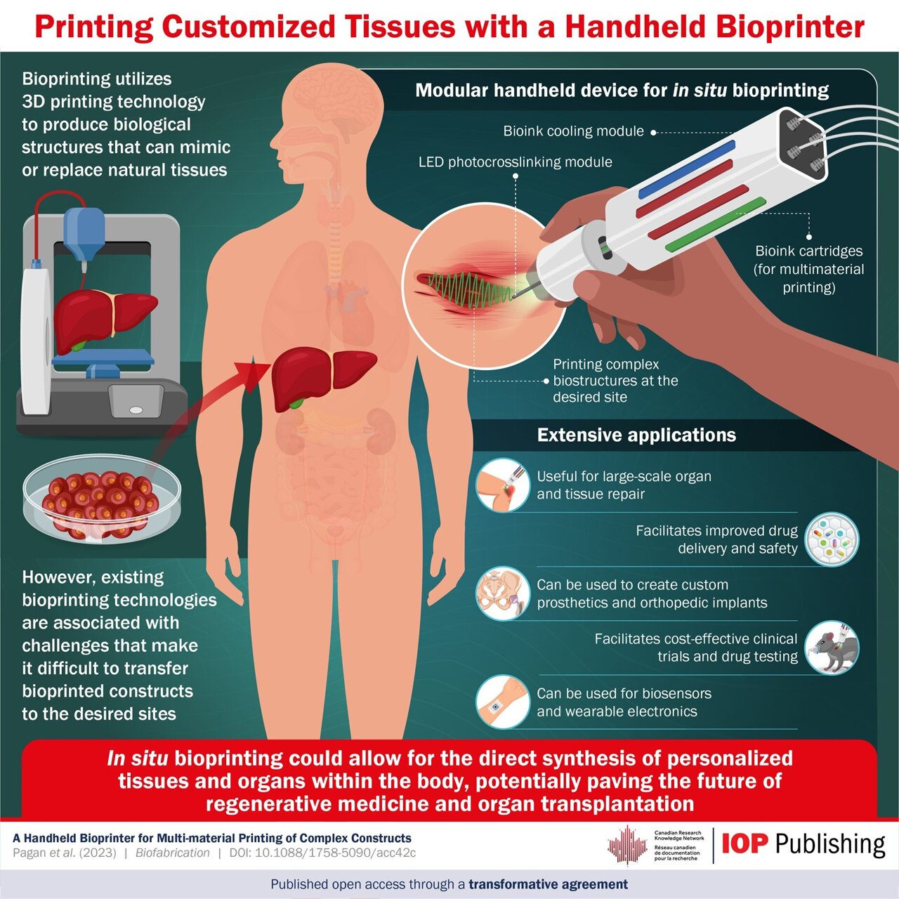 Bioprinting personalized tissues and organs within the body: A
