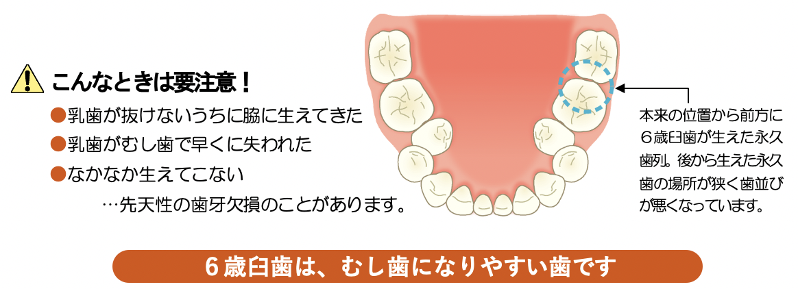 6歳臼歯（第一大臼歯）の萌出｜聖護院やぎ歯科・矯正歯科｜京大病院