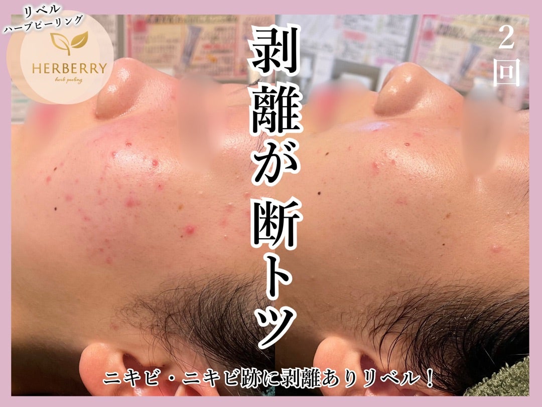 ポテンツァ、リジュランより剥離ありハーブピーリング | ハーブ