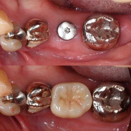 インプラントによる咬合回復 | 江東区北砂の歯医者【砂町北歯科】歯周